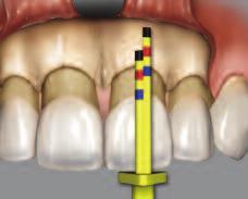 Papilla tip is used to determine the aesthetically ideal position of the interdental papilla before the flap is
