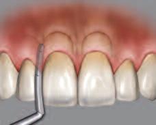 It is used in aesthetic and periodontal crown lengthening procedures to determine the bone level before reflecting