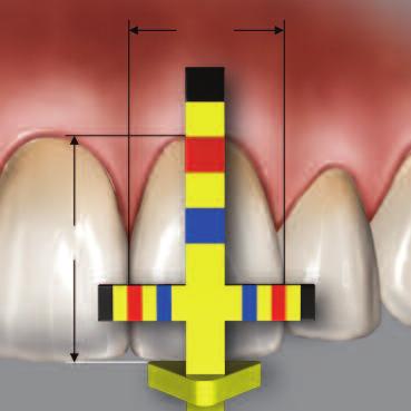 T-BAR TIP IN USE Measure the central incisor first. Hold the Proportion Gauge using a pen grasp with the T-bar facing up.