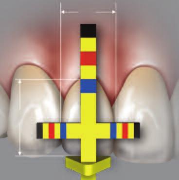For the central incisor, the length and width should be at the outer margin of the red band on the vertical and horizontal arm respectively. This ensures that the tooth is in correct proportion.