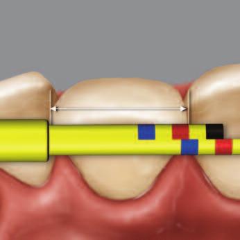IN-LINE TIP The In-line tip is designed to measure tooth width with its short arm and length with its long arm independently.