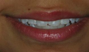 Simplified Smile Design: Everyday Predictability Part I CLINICAL REVIEW Charles R.