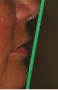 Figure 3: Profile view of a patient showing the relative positions of the lips to the Rickett s E-line, indicated by the green straw.