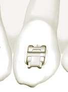 best seen from this angle, particularly in the premolar, canine and anterior regions.