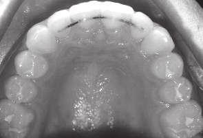If viewed from buccal, 1st premolar placement will appear too distal; 2nd premolar too mesial. O-G: Position occlusal edge of bracket wings at the M-D contact line.