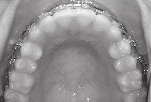 Smile/Miniesthetics 1 : Asymmetric smile with low commissure on the right, adequate incisal display and smile arc, good upper midline position but severe crowding, narrow arches and large buccal