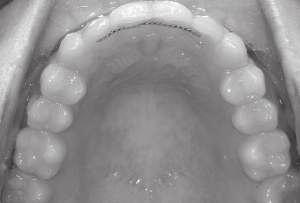 Incisors bell-shaped with minimal connector areas for contacts. Lower midline shifted 5 mm to left. U2s in lingual crossbite with dilacerated LR5 root tip.
