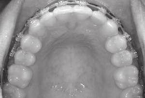 (Invert STD torque on upper incisors with +12º becoming -12º for 1s; +8º becoming -8º for 2s. Use low torque on L3-3.) Minimize exacerbation of labiogingival recession.