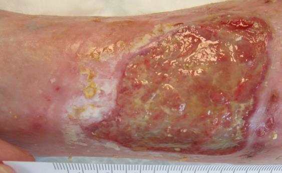 Xylocaine gel in place Diagnosis of tissue type, bio burden and factors that influence debridement T= thick tenacious slough, unhealthy, friable, biofilm, biopsy NAD I = not infected, very sore to