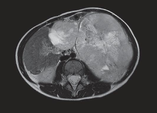 aspect of the large tumor,