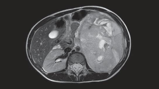 (D, G) are shown. (Arrows pointing to lung metastases.