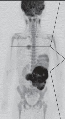 corresponding T2w image (B) demonstrating the tumor