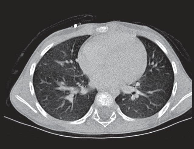 7A 7B 7 Follow-up examination with CT (A) still showing a small residual