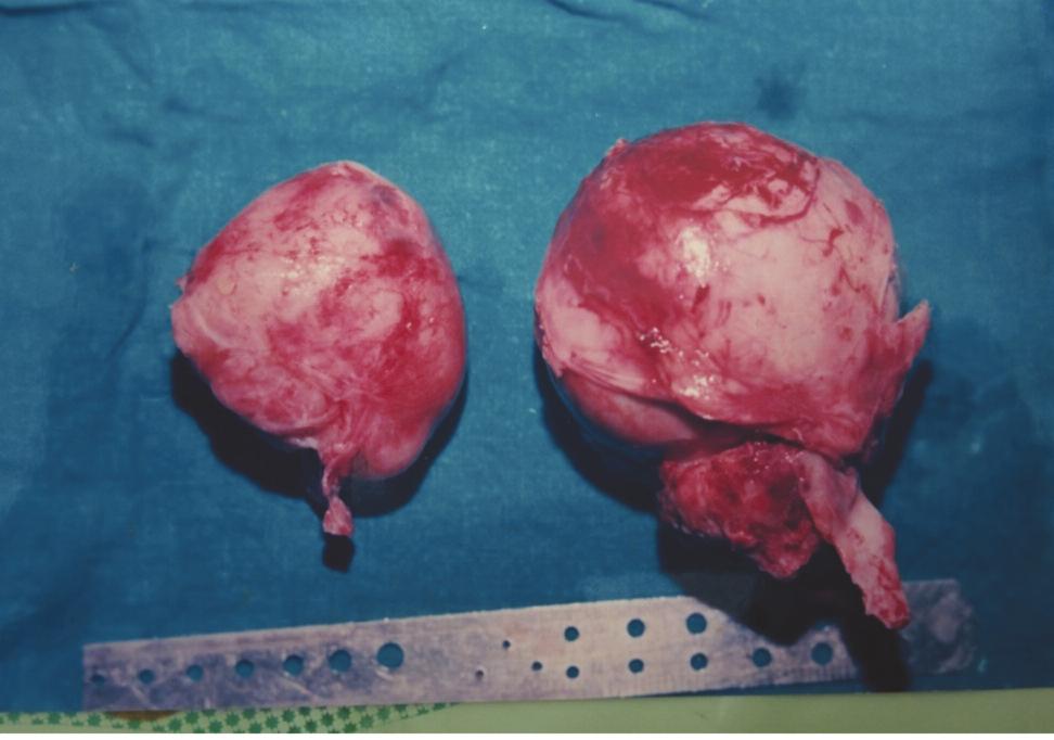 Wilms Tumor: Histopathological Variants and the Outcomes with age (less than or more than 2 years), sex, stage at presentation and histology.