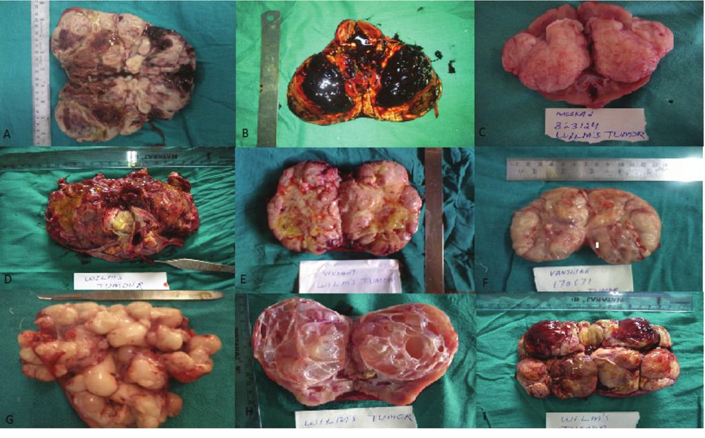 Pradeep Kajal et al. Discussion Wilms tumor (nephroblastoma), an embryonal type of renal cancer, is one of the most common solid malignant neoplasms in children.