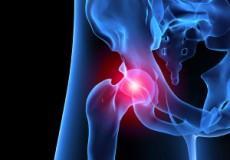 A patient guide to Hip Impingement Non-Surgical