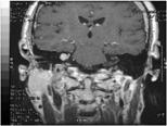 Downbeating Nystagmus may be clue to underlying cerebellar degeneration or Chiari Chiari Malformation Chiari Malformation Treatment: Suboccipital