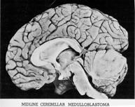 vestibulocerebellum Hydrocephalus (projectile vomiting) and cerebellar signs. Treat with resection, chemotherapy and radiation.