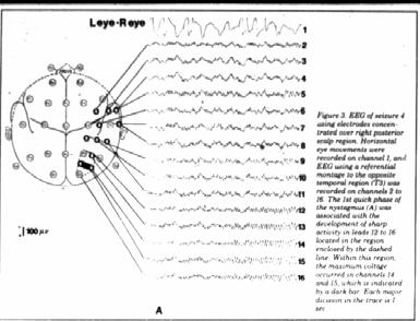 EEG shows seizure during nystagmus In the clinic he had a spell of dizziness with clear nystagmus Seizures causing Dizziness Quick spins (1-2 seconds) Also caused by vestibular nerve irritation