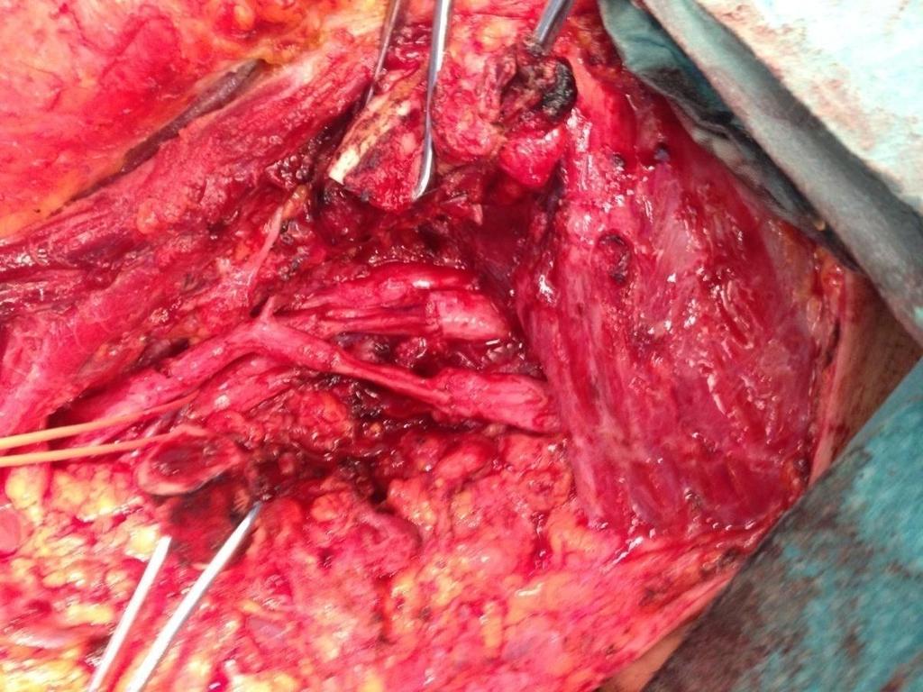 Total exploration of the right brachial plexus which showed the interruption of the medial cord & the MC nerve to its origin on the lateral cord, with a compressive