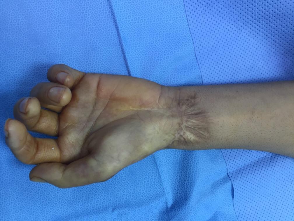 Bullet injury to the left wrist with total laceration of the median nerve in a 42 year-old-man The patient presented to us two years after the