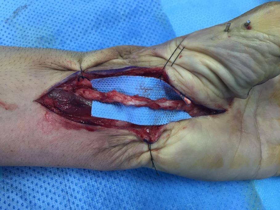 Bullet injury to the left wrist with total laceration of the median