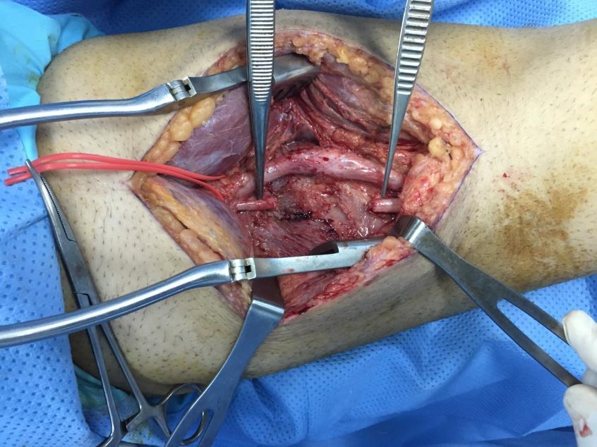 Neuroma excision / nerve graft of the common