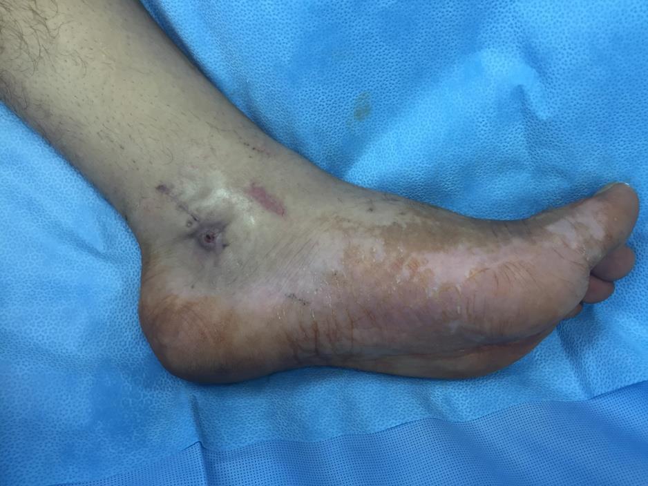 Shrapnel injury to the medial side of the left ankle in