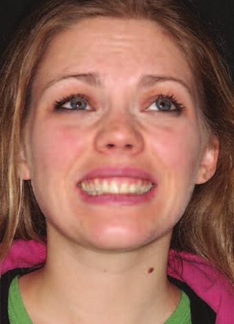 Fig. 8d: Full Face Frontal High Smile with gingival display-pre Botox-first appointment Fig. 8e: Full Face 45` Right High Smile with gingival display -pre Botox-first appointment Fig.