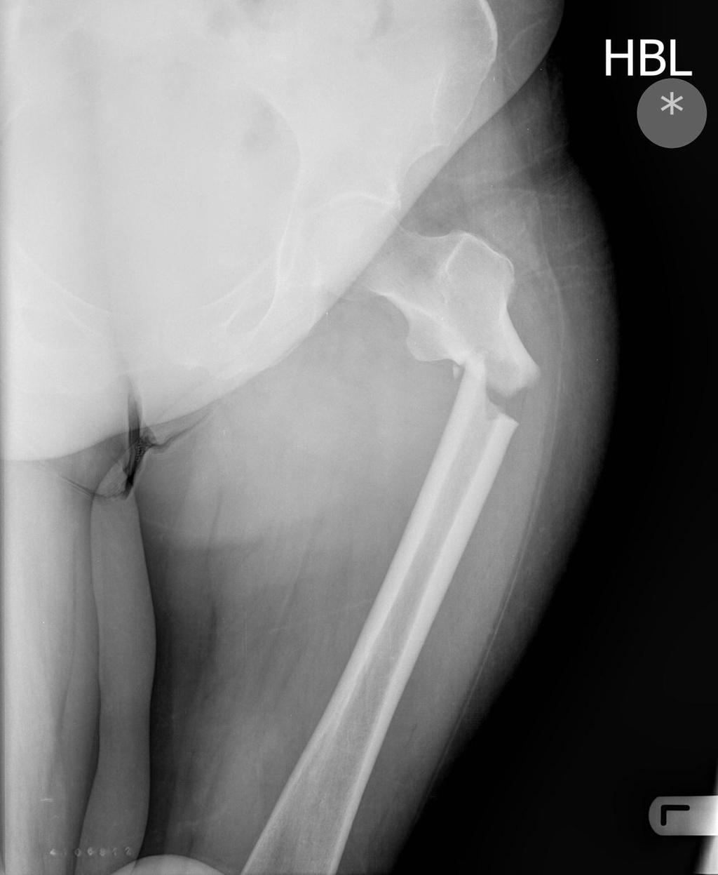 Atypical femoral fractures 57 y/o