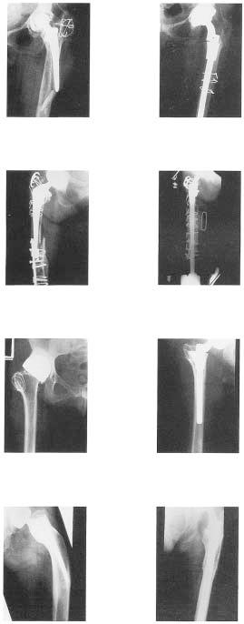 CLINICAL EXAMPLES (continued) Crack (Stem Perforation) Fracture