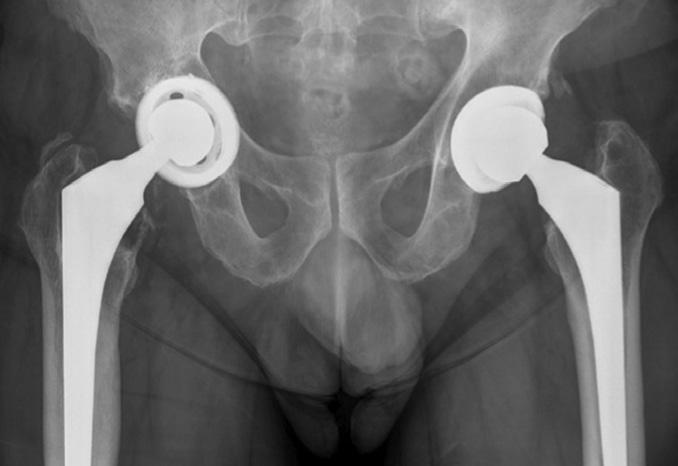 ossification underwent excision of the heterotopic ossification with postoperative single-dose radiation therapy (700 rads) 1 year following revision THA.