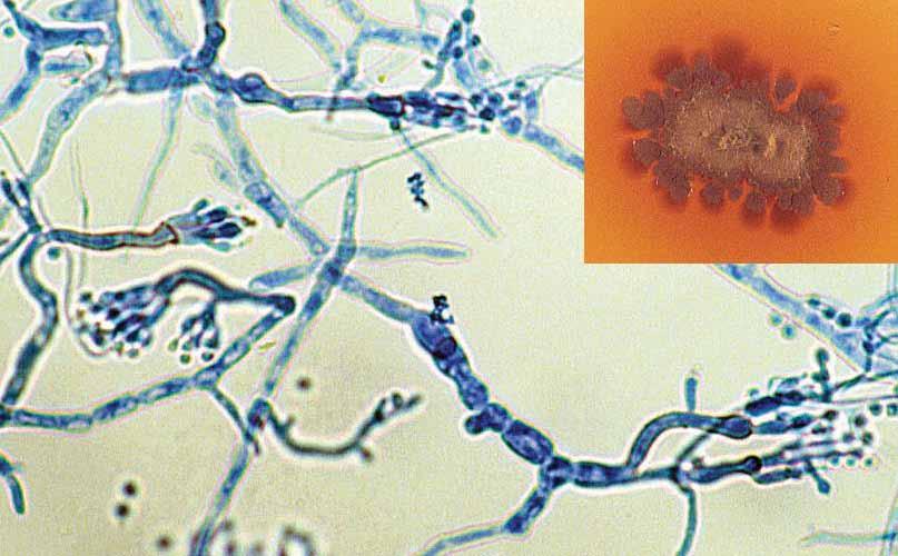Descriptions of Medical Fungi 117 Madurella complex The genus Madurella was originally based on tissue morphology (mycetoma with black grains) and the formation of sterile cultures on mycological