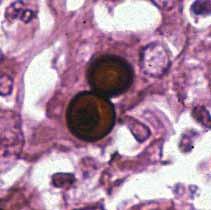 Descriptions of Medical Fungi 33 Blastomyces dermatitidis Gilchrist & Stokes 10 μm Histopathology: Blastomyces dermatitidis tissue sections show large, broad-based, unipolar budding yeast-like cells,