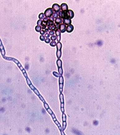 86 Descriptions of Medical Fungi Exophiala dermatitidis has been isolated from plant debris and soil and is a recognised causative agent of mycetoma and phaeohyphomycosis in humans (Zeng et al. 2007).