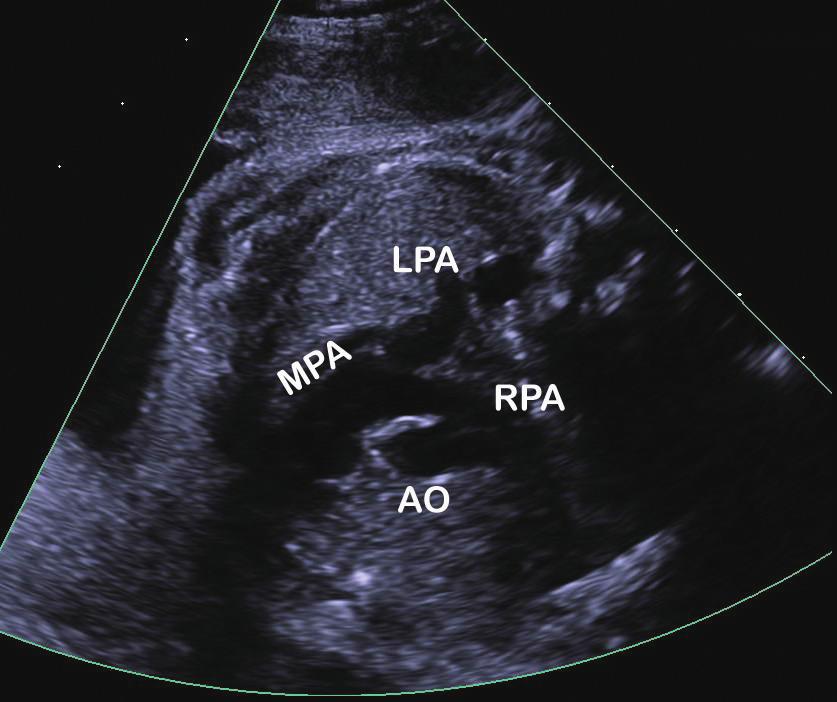 E: the ductus joined the descending aorta at an obtuse angle. F: color aliasing occurred through the DA (arrow).
