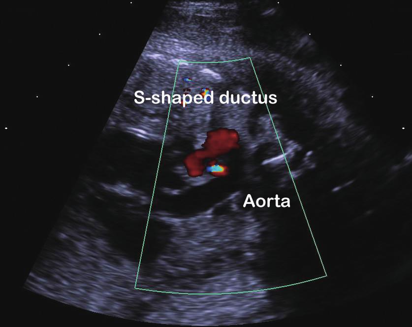 The main pulmonary artery bifurcated into two branch pulmonary arteries but was not continuous with the DA (Fig. 1B).