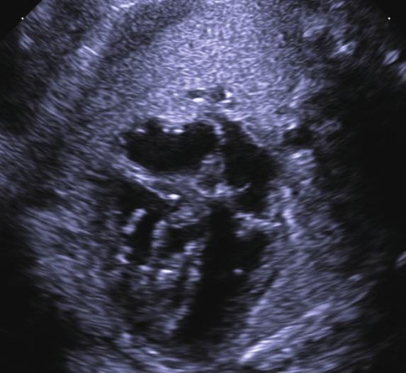 776 Progressive Ductal Constriction in a Fetus A B C Fig. 2. Follow-up echocardiography at 27 weeks showed significant changes in right ventricular morphology and function.