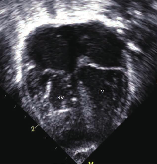 Eun Young Choi, et al. 777 A B C D E F Fig. 3. Post-natal echocardiography was performed within few hours after birth.