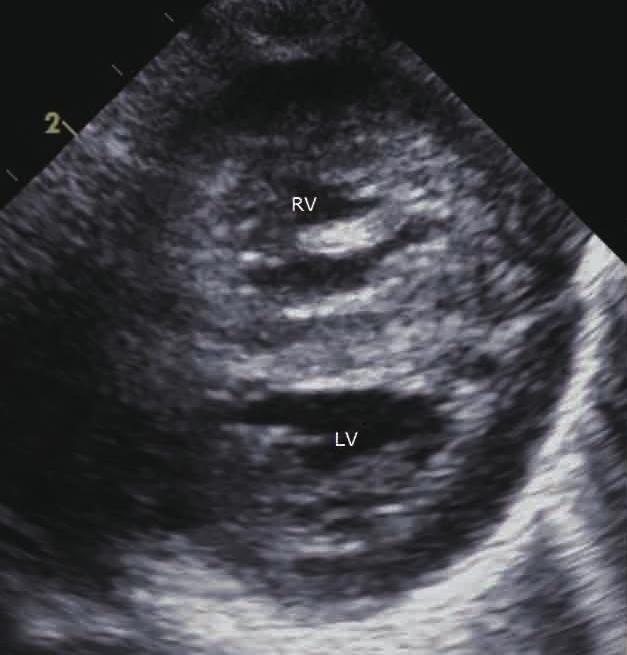 C: TR velocity was slightly decreased compared to the previous examination during fetal life. D: hypertrophied RV and moderator band are apparent in the short axis view.