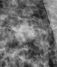 Digital mammography image of an invasive ductal carcinoma.