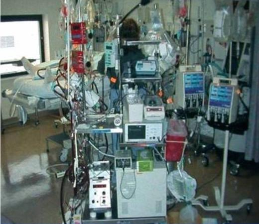 ECMO v1, 1975-2008 It works BUT, very complex It can fail suddenly with blowout,