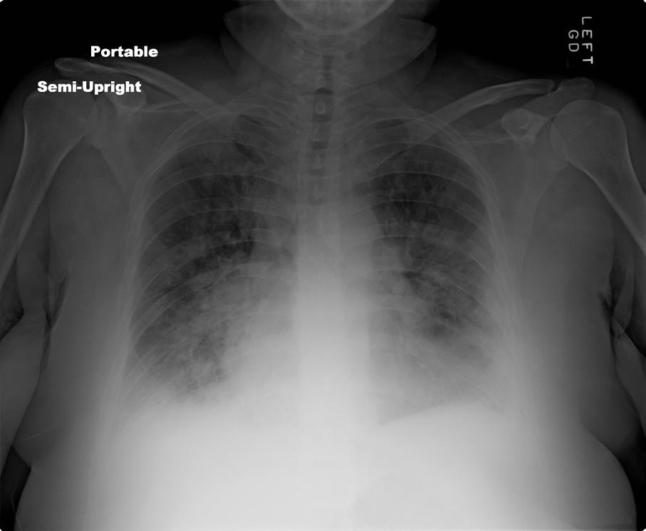 RADIOGRAPHIC FEATURES Diffuse bilateral infiltrates Patchy, confluent Alveolar,
