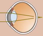 34. What is the name of this condition where the image would project behind the retina, and what type of lens would be