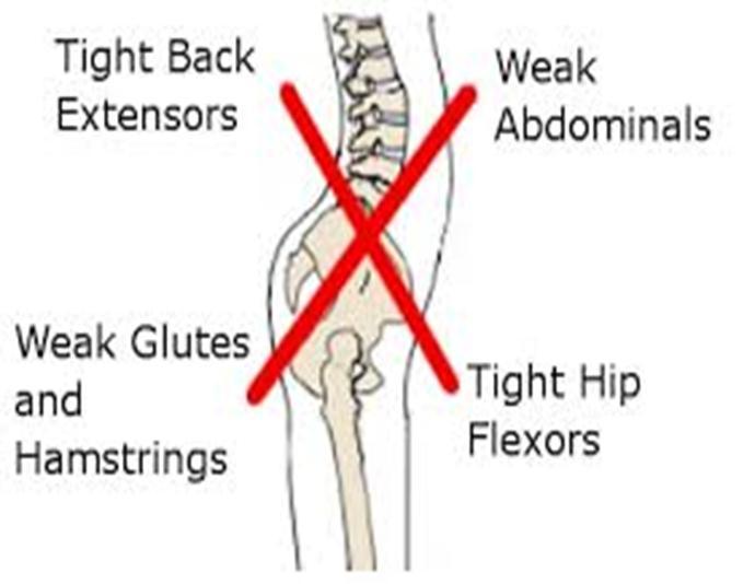 Anterior Tilt is a forward tilt of the hips often due to an over-active