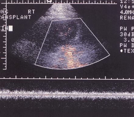 Figure 18a. Severe transplant rejection. (a) Duplex color Doppler US image shows a spectral waveform in which the arterial flow in diastole is reversed.