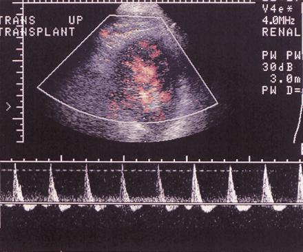 (b) On another duplex image, the spectral waveform shows that the renal vein is patent, thus the diagnosis of renal vein thrombosis is excluded. Findings from biopsy confirmed transplant rejection.