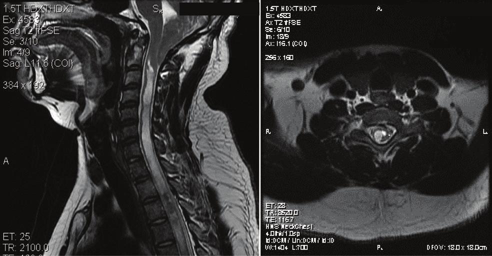 Patient with persistence of symptoms had long duration of symptoms, inferior tonsillar [Table/Fig-5]: First image-mri Brain T1 sagittal image show inferior herniation of cerebellar tonsil.