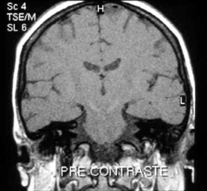 2 identified abnormalities using MRI in 34.