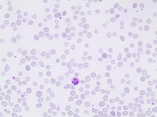 Erythrocyte case studies /Anemia Macrocytosis, Dimorfic presence Case D21b Diagnosis: This case is a continuation of the previous case D21a He receives two units of packed red blood cells, and